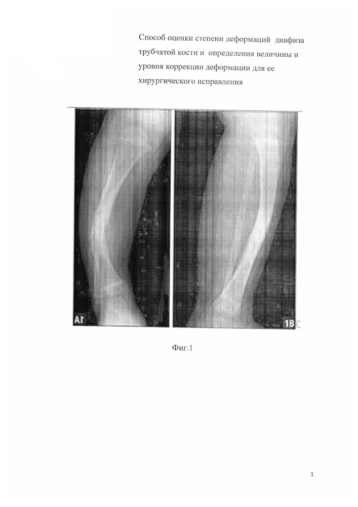 Способ оценки степени деформаций диафиза трубчатой кости и определения величины и уровня коррекции деформации для ее хирургического исправления (патент 2600070)