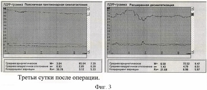 Способ комбинированной десимпатизации у больных с хронической ишемией нижних конечностей (патент 2441603)
