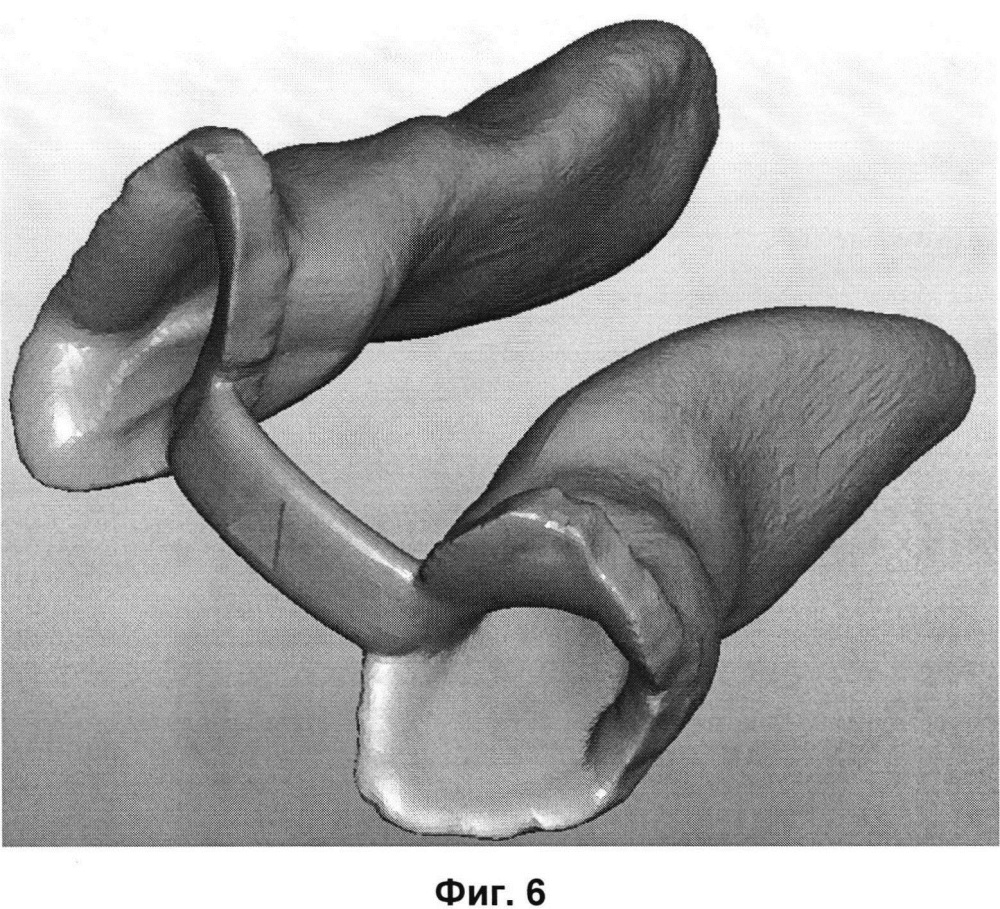 Способ изготовления назального стента для лечения пациентов с врождёнными аномалиями развития и приобретёнными деформациями челюстно-лицевой области (патент 2618187)
