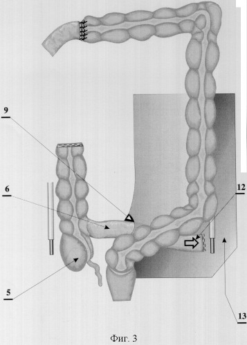 Способ илеоцекоцистопластики (патент 2323688)
