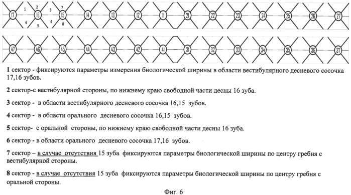 Способ создания трехмерного дизайн-проекта краевого пародонта (патент 2508068)