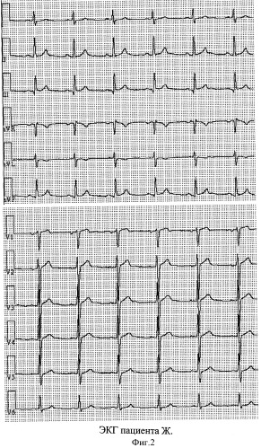 Способ электрокардиографической диагностики гипертрофии миокарда левого желудочка у больных артериальной гипертонией с избыточной массой тела (патент 2344754)
