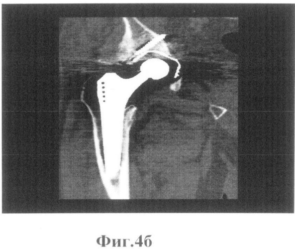 Способ исследования мягких тканей параартикулярной зоны в эндопротезировании тазобедренного сустава (патент 2496423)