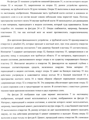 Имплантаты для создания соединений с тканями, в частности со скелетом, а также устройство и способ имплантации (патент 2314768)