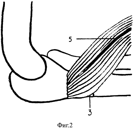 Способ оперативного лечения ложных суставов проксимального отдела локтевой кости (патент 2564800)