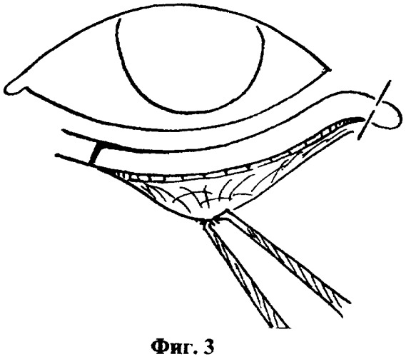 Способ хирургического лечения заворота нижнего века (патент 2342917)