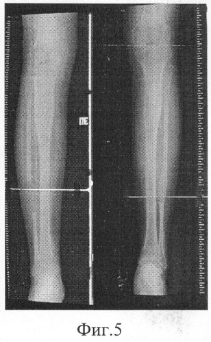 Способ удлинения трубчатой кости (патент 2271766)