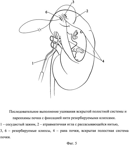 Способ одномоментного закрытия раны и полостной системы почки при лапароскопической резекции (патент 2532942)