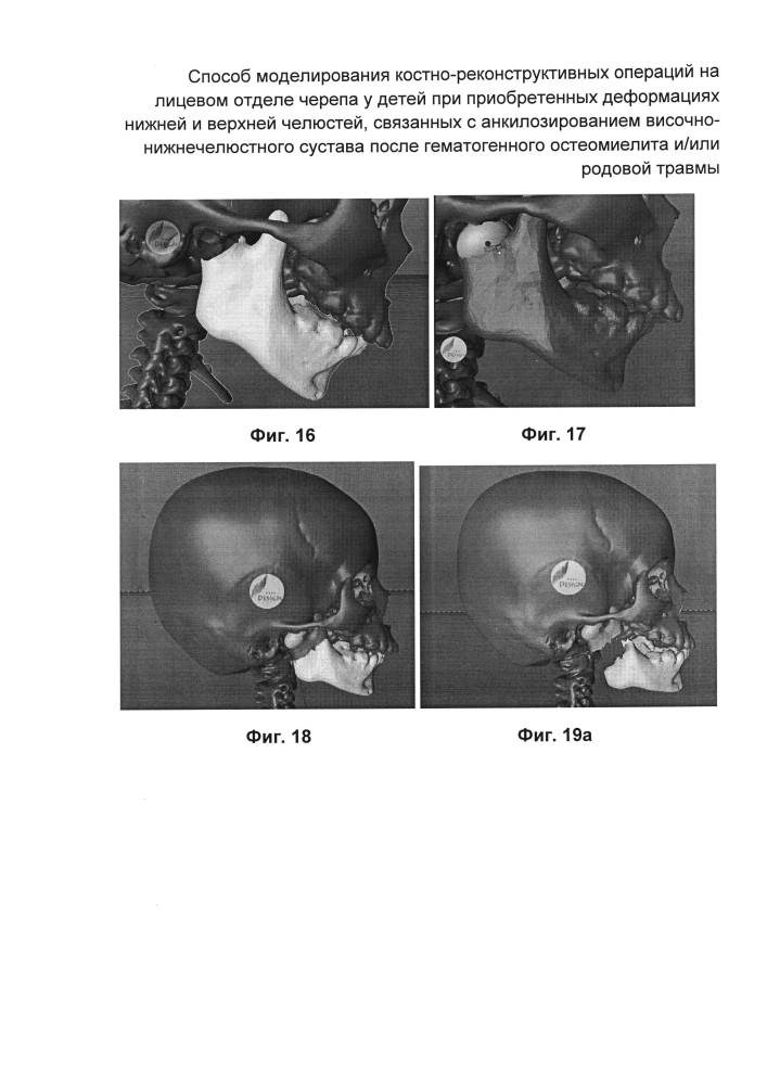 Способ моделирования костно-реконструктивных операций на лицевом отделе черепа у детей при приобретенных деформациях нижней и верхней челюстей, связанных с анкилозированием височно-нижнечелюстного сустава после гематогенного остеомиелита и/или родовой травмы (патент 2604774)