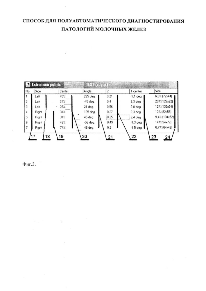 Способ для полуавтоматического диагностирования патологий молочных желёз (патент 2622362)