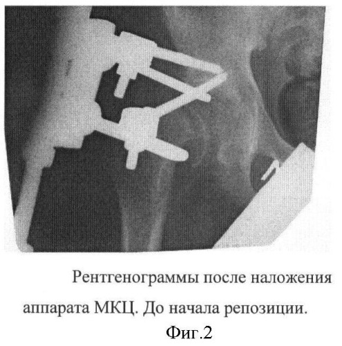 Способ лечения юношеского эпифизиолиза головки бедренной кости у детей (патент 2422110)