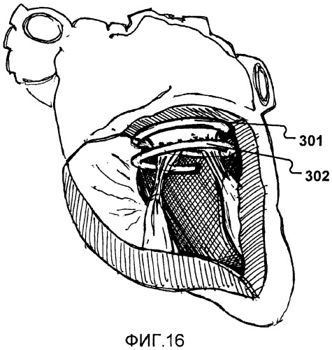 Устройство и способ для уменьшения размера клапана сердца (патент 2491035)