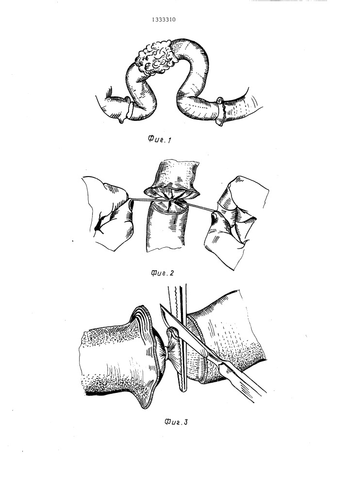 Способ анастомозирования кишечника (патент 1333310)