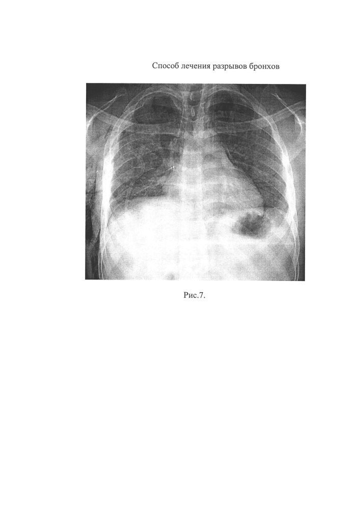Способ лечения разрывов крупных бронхов (патент 2651691)