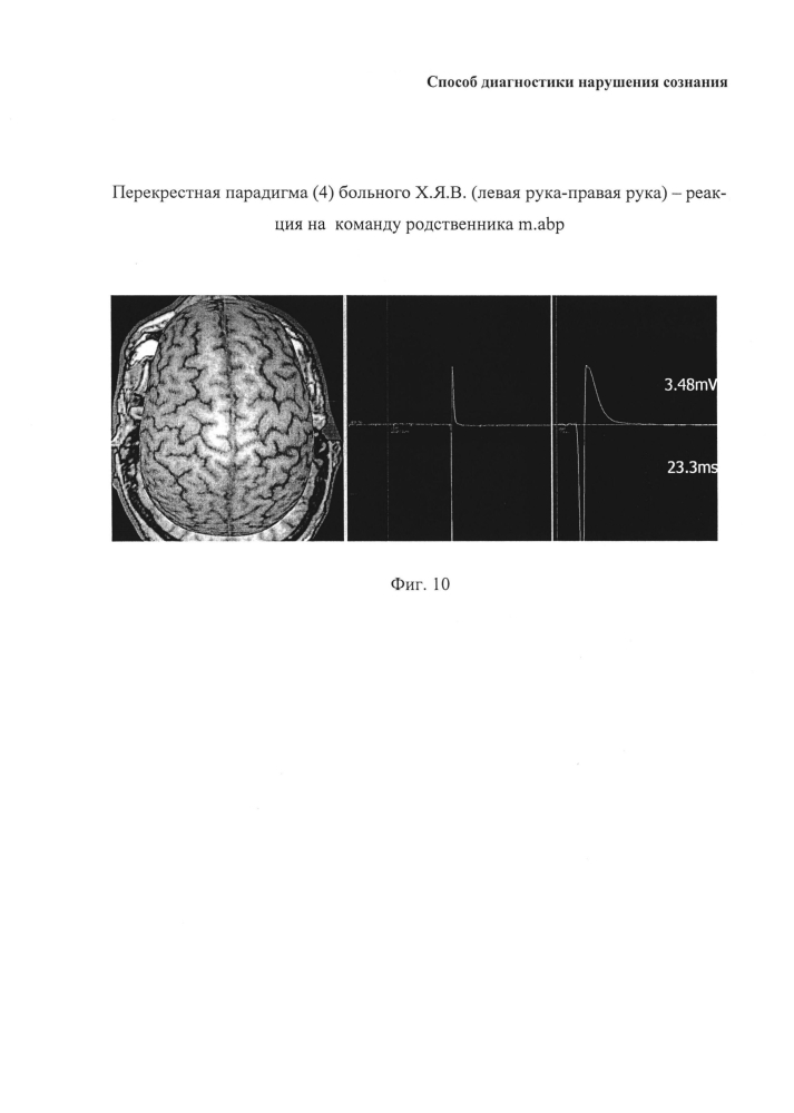 Способ диагностики нарушения сознания (патент 2596049)