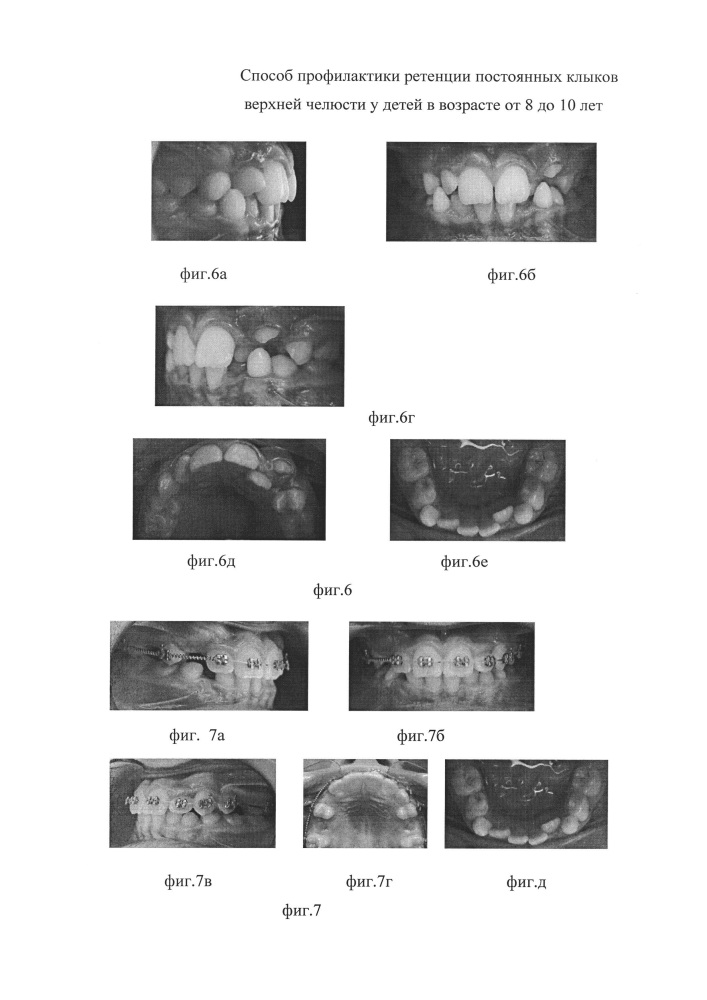 Способ профилактики ретенции постоянных клыков верхней челюсти у детей в возрасте от 8 до 10 лет (патент 2633479)