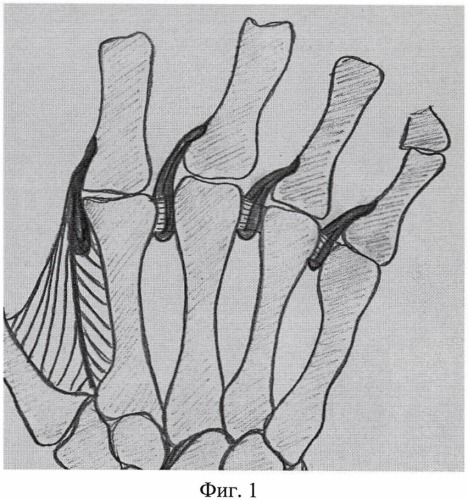 Способ устранения ульнарной девиации трехфаланговых пальцев кисти при ревматоидном артрите (патент 2447852)