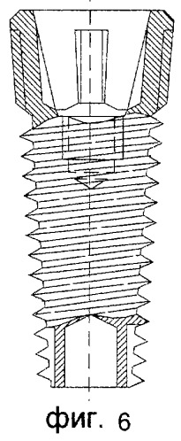 Стоматологический имплантат (патент 2262324)