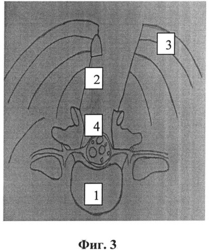 Способ реконструкции позвоночного канала при лечении стеноза пояснично-крестцового отдела позвоночника (патент 2531927)