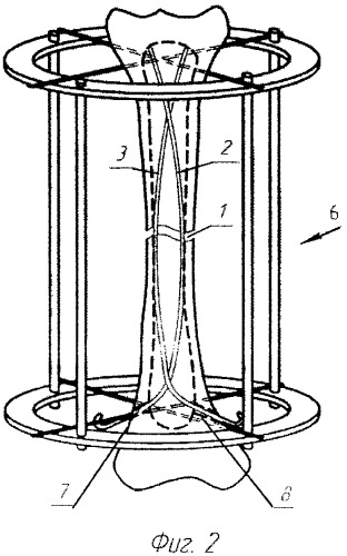 Способ лечения переломов длинных трубчатых костей (патент 2317034)
