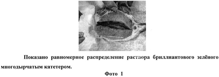 Способ преперитонеальной блокады после герниопластики срединных послеоперационных вентральных грыж (патент 2529412)