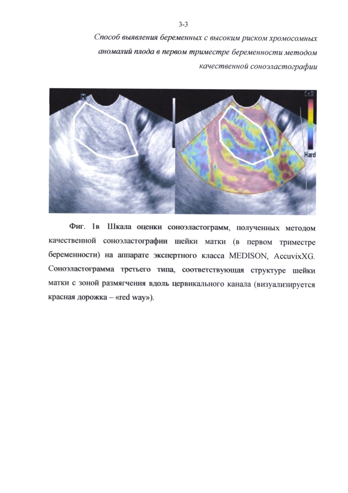 Способ отбора беременных женщин для проведения инвазивной диагностики хромосомных аномалий плода в первом триместре беременности методом качественной соноэластографии (патент 2626144)