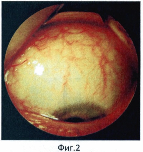 Способ исследования кровообращения переднего сегмента глаза (патент 2403857)