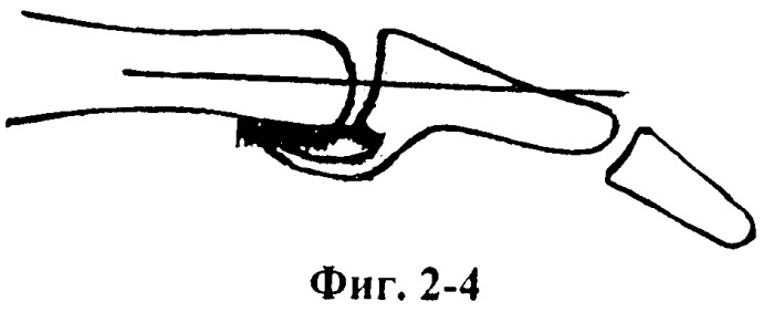 Способ лечения разгибательной контрактуры пальца в проксимальном межфаланговом суставе (патент 2464947)