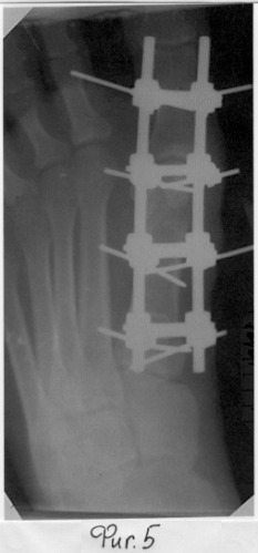 Способ хирургической реабилитации больных с &quot;hallux valgus&quot; (патент 2259174)