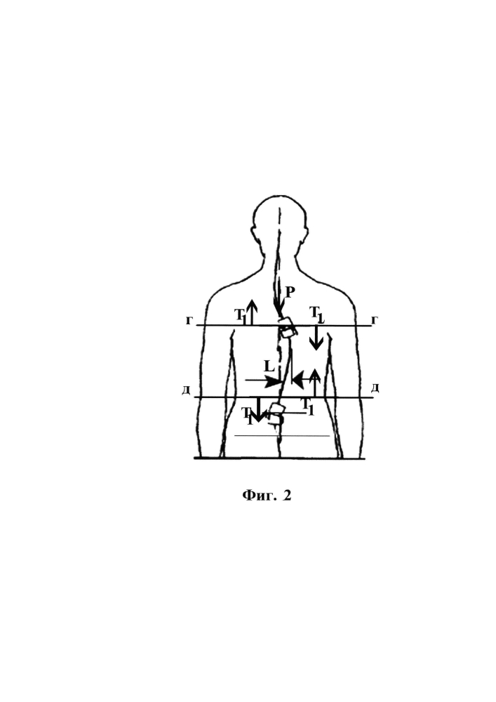 Устройство для лечения искривления позвоночника (патент 2600280)