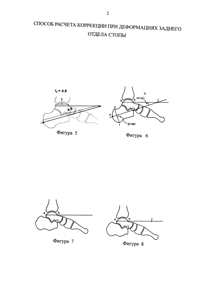 Способ расчета коррекции при деформациях заднего отдела стопы (патент 2634043)