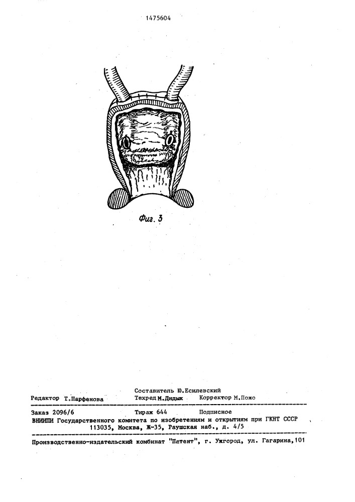 Способ формирования искусственного мочевого пузыря (патент 1475604)