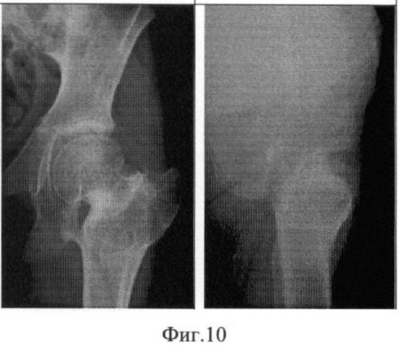 Способ лечения шеечно-эпифизарной деформации бедра (патент 2424778)