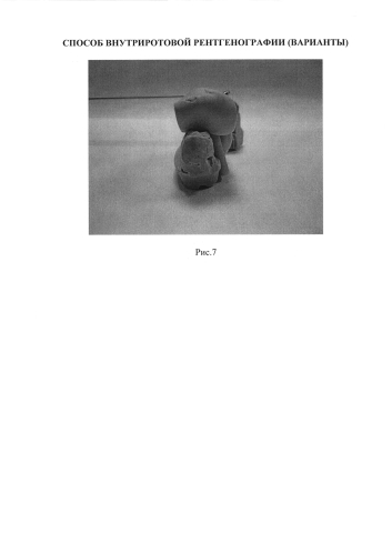 Способ внутриротовой рентгенографии (варианты) (патент 2576873)