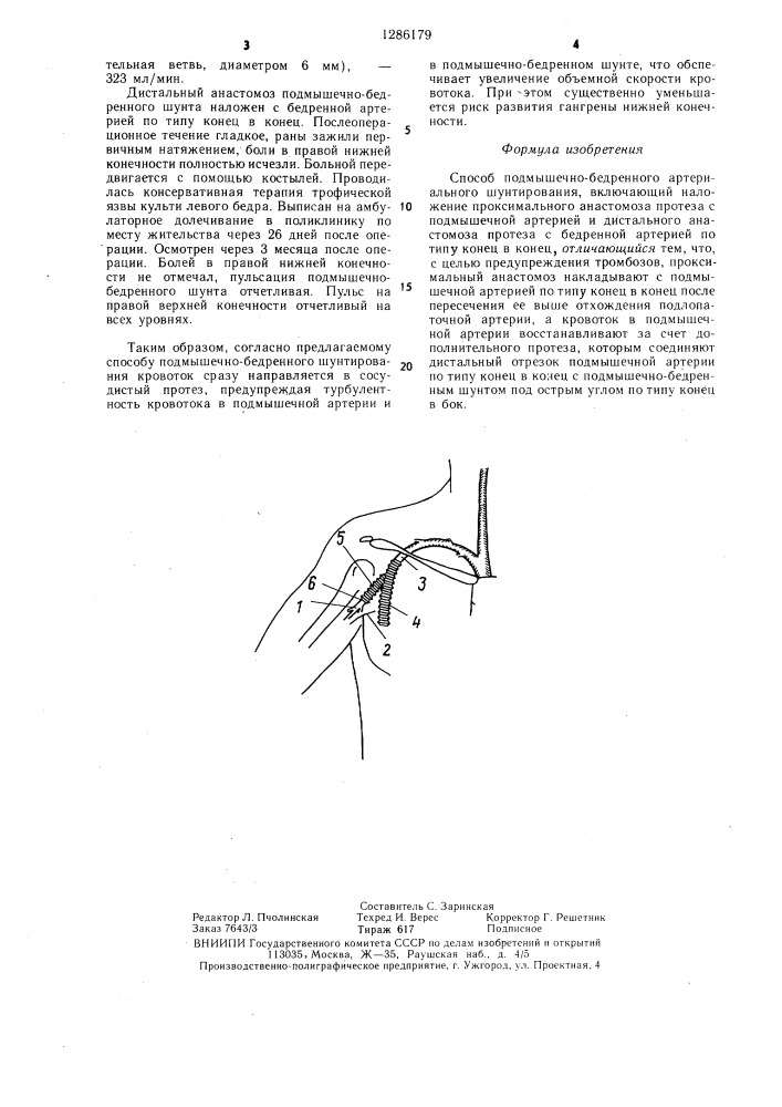 Способ подмышечно-бедренного артериального шунтирования (патент 1286179)
