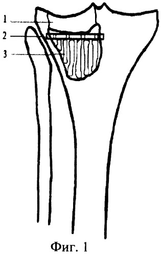Способ пластики костного дефекта проксимального отдела большеберцовой кости (патент 2344777)