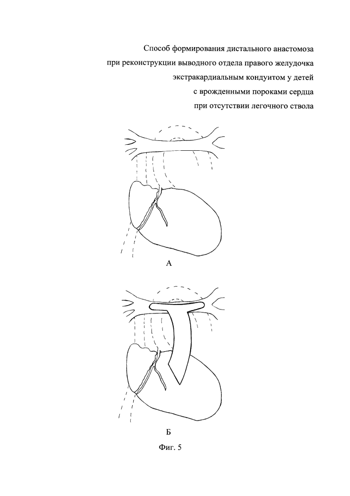 Способ формирования дистального анастомоза при реконструкции выводного отдела правого желудочка экстракардиальным кондуитом у детей с врожденными пороками сердца при отсутствии легочного ствола (патент 2644937)