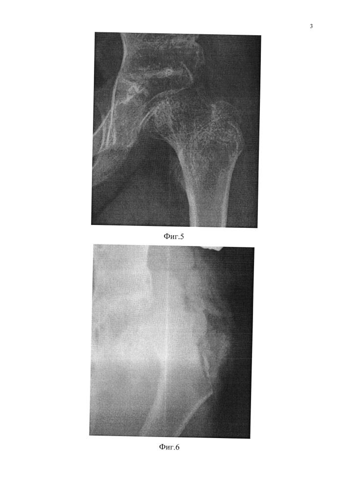 Способ лечения дефекта головки бедра (патент 2637290)