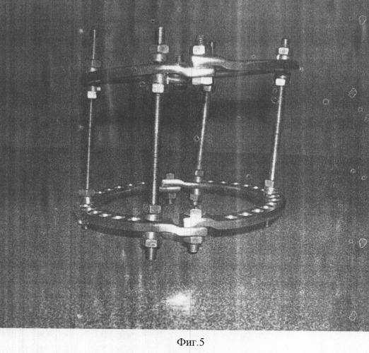 Аппарат внешней фиксации для интраоперационной репозиции и стабилизации положения посттравматических отломков костей (патент 2314767)