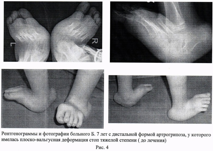 Способ лечения врожденной плоско-вальгусной деформации стоп тяжелой степени у детей с артрогрипозом (патент 2493793)