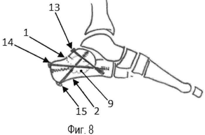 Способ оперативного лечения закрытых оскольчатых языкообразных переломов пяточной кости (патент 2520800)