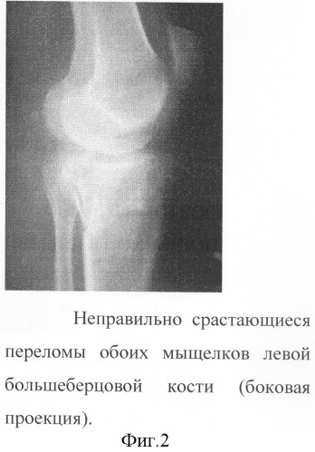 Способ остеосинтеза с использованием костной аллопластики (патент 2299028)