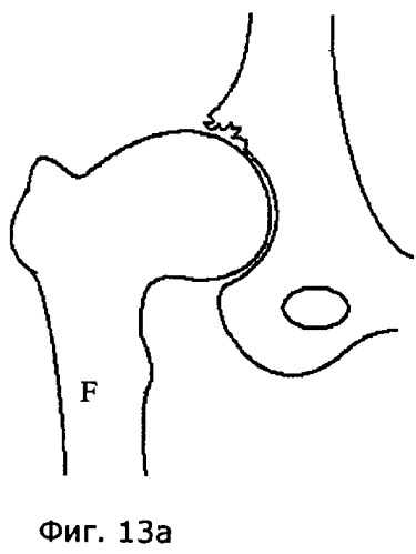 Устройство и способ для лечения бедренно-вертлужного соударения (патент 2506928)