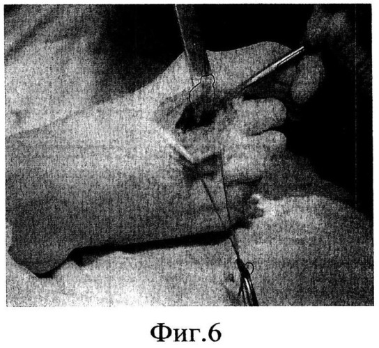 Способ хирургического лечения остеомиелита головки второй плюсневой кости (патент 2543629)
