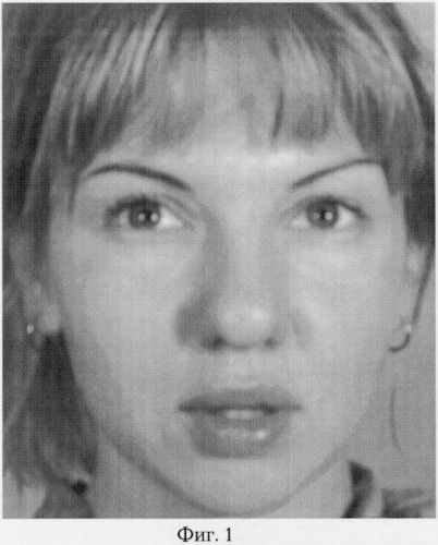 Способ реконструкции формы кончика носа (патент 2268667)