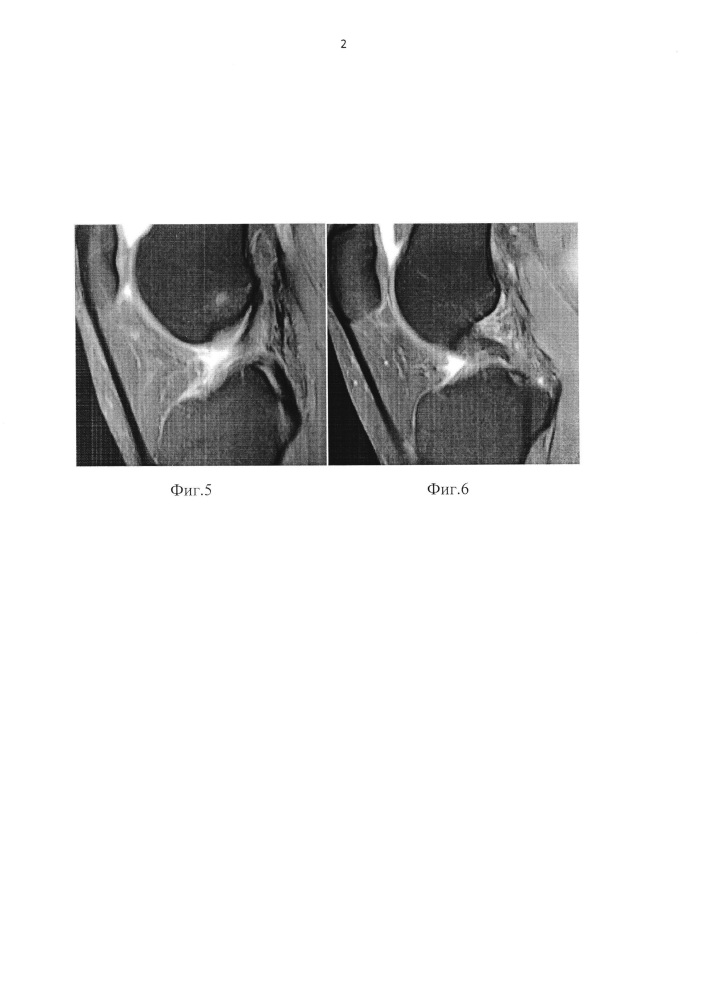 Способ диагностики внутренних структур коленного сустава при магнитно-резонансной томографии (патент 2656562)