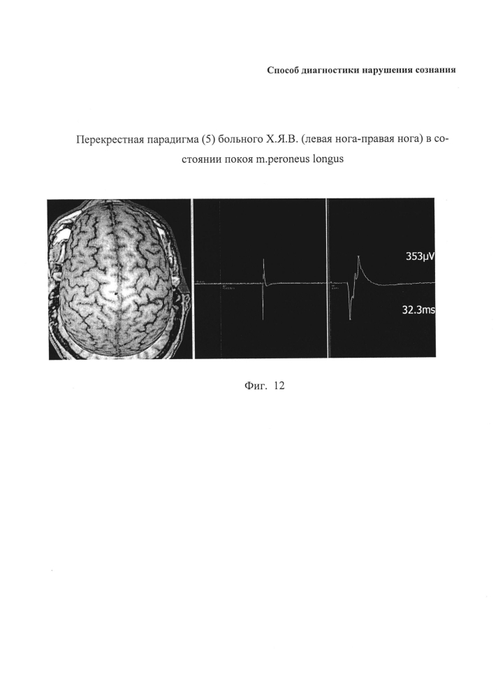 Способ диагностики нарушения сознания (патент 2596049)