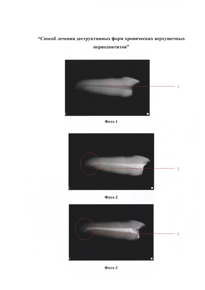 Способ лечения деструктивных форм хронических верхушечных периодонтитов (патент 2624166)