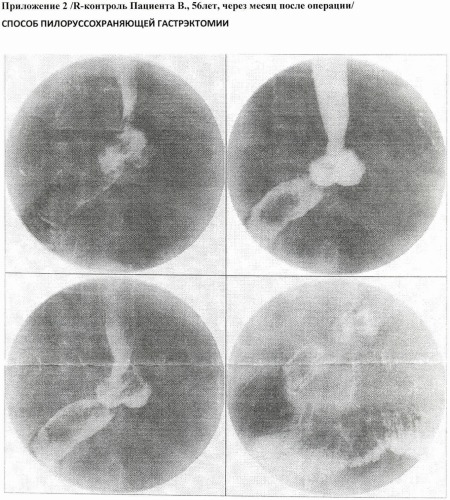 Способ пилоруссохраняющей гастрэктомии (патент 2417771)