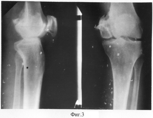 Способ и устройство для лечения посттравматического гонартроза (патент 2282412)